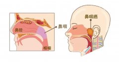 别把癌症当鼻炎，警惕鼻咽癌早期症状！